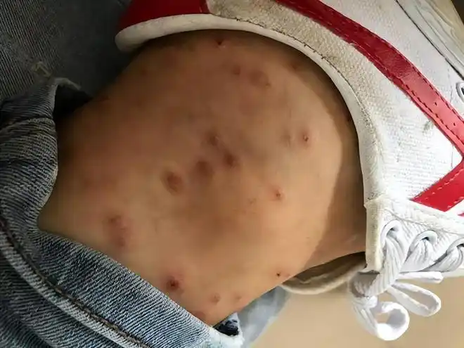 广东5月是蠓虫高发期,连无蚊无蛇的冰岛都有分布,它有多烦人?|蚊子|飞