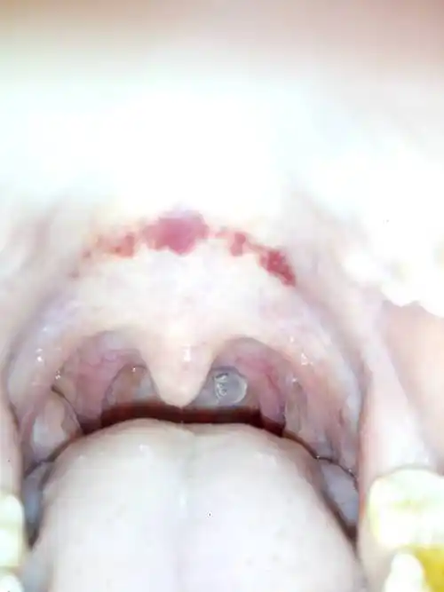 喉咙上面痛,红了,昨晚打了很多哈欠,还流鼻涕,现在