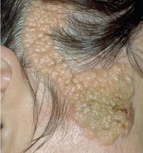 说文解痣——皮脂腺痣