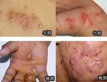 皮肤病医院专家指出:疥疮主要是由皮内疥螨引起,疥螨是一种皮内寄生虫
