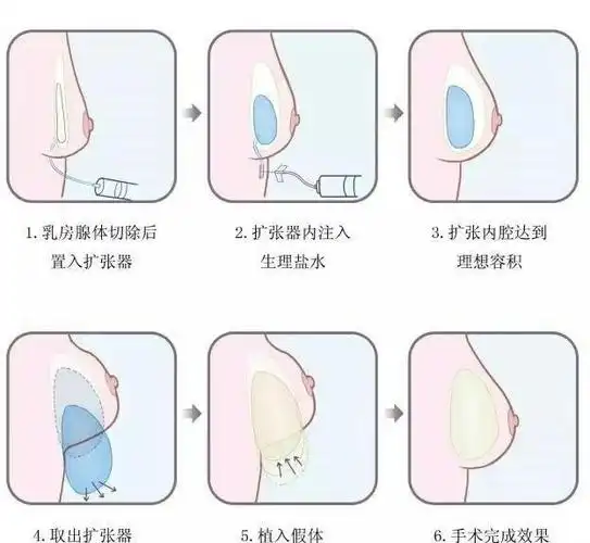 乳腺癌一期假体再造术后注意事项_乳房重建术_治疗介绍_护理及注意