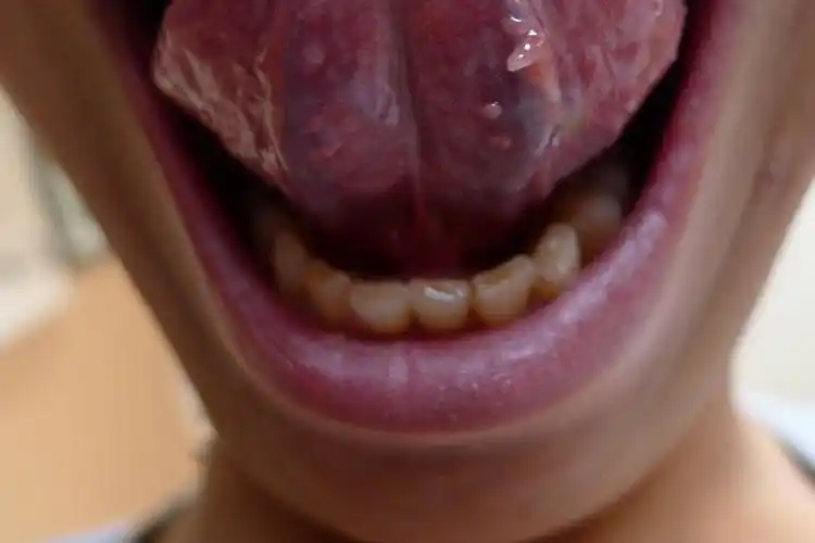 或因接触感染者的衣物,用具等,发生间接传播,导致病毒进入口腔,大量