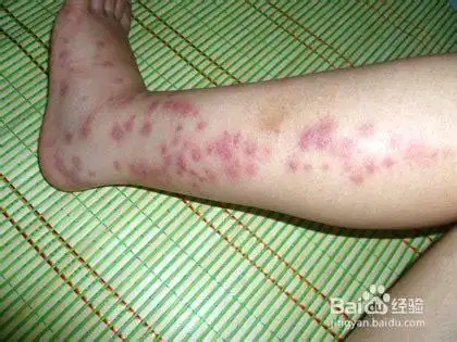 小腿皮肤瘙痒图片大全