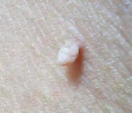 皮肤上长的小肉疙瘩是什么?