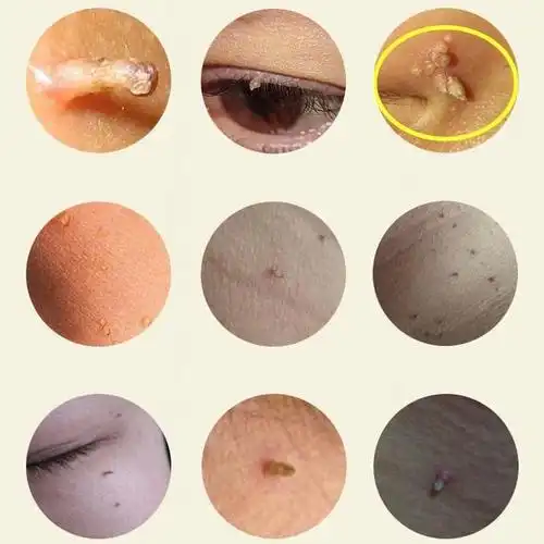 关于皮肤疣 - 微医(挂号网)