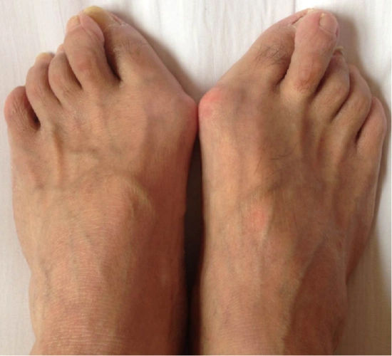 脚拇指外翻(拇外翻)畸形怎么办?