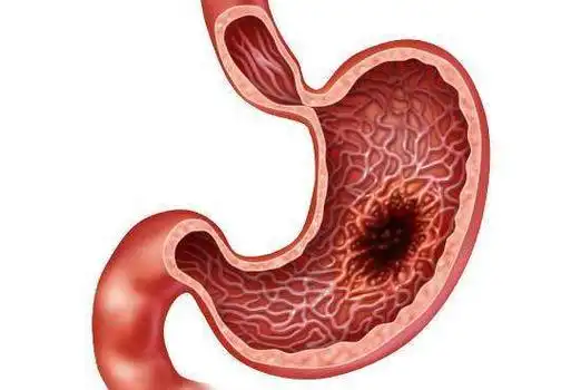 慢性胃炎饮食,胃溃疡饮食