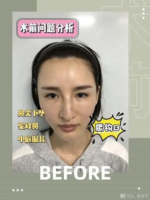 7515她鼻子之前没有做过,鼻部皮肤空间足够,张力不是很大7515