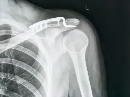 锁骨远端骨折经典术式