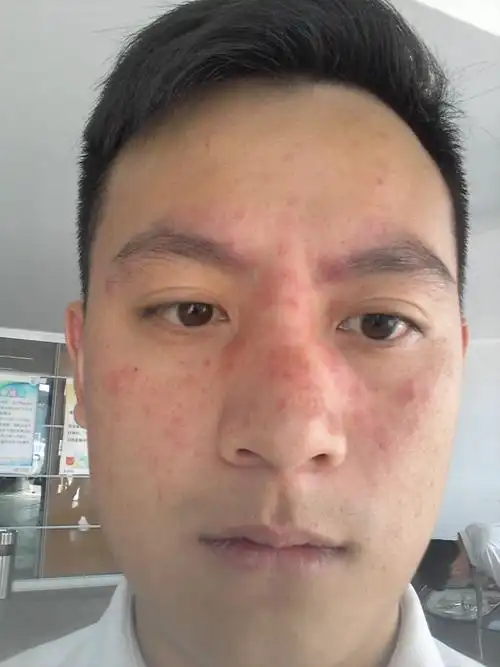 问:脸上起红斑,请各位专家帮忙看看