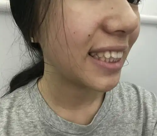 大家觉得我凸嘴算严重吗要不要二次矫正