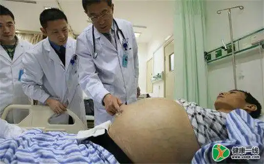 患者的痛苦不是一般人能了解的,那么到底患有肝腹水的病人会有哪些