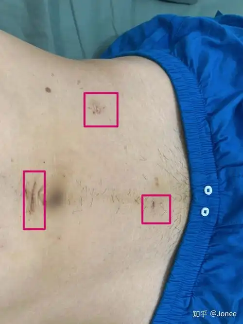 手术后十天出院5天肚子伤口也基本愈合 ,结痂开始脱落,没有疼感了,用