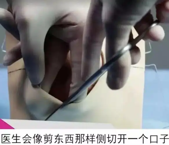 顺产很轻松 为了让孩子顺利娩出 多数医生会实行在局部 麻醉后侧切 像