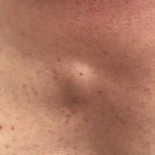 爸爸的胸口鼓起来一个包,按上去还能动,以前小一些