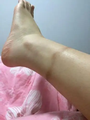 穿九分裤,风吹的,脚腕一圈黑,裂了.怎么办?怎么恢复?