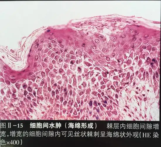 儿童湿疹知多少