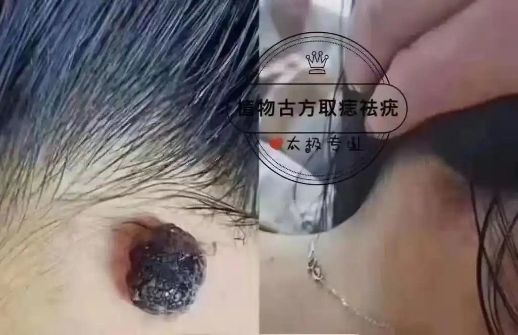 问题性皮肤管理 藏在头发里的大血管痣[恐惧]头部位置:梳头 - 抖音