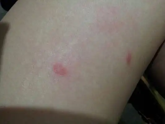 艾滋病红点图片 (7)