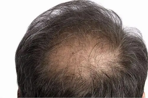 滋森漫:脂溢性脱发初期的症状,男性与女性的表现有什么不同呢?