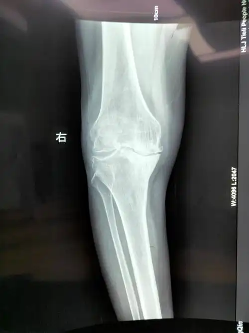 术前检查的膝关节x线