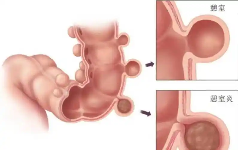 腹部反复疼痛,中年男子被查出"结肠憩室",严重可失血性休克_高峰_肠壁