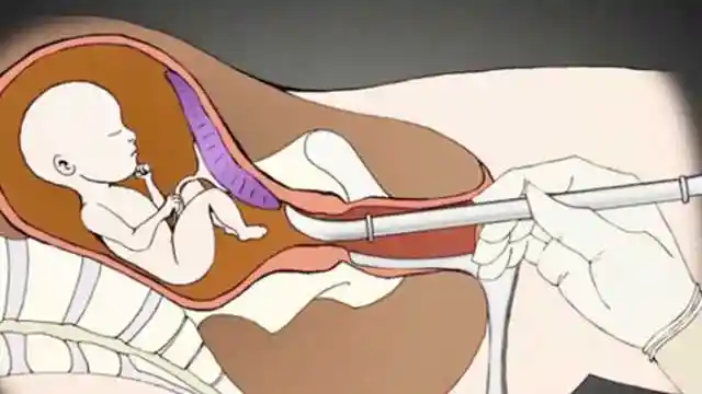 人流手术有多残忍3d动画还原打胎全过程看完不寒而栗