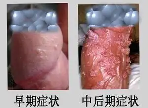 珍珠丘疹是在阴茎的冠状沟处环绕龟头出现的淡红色小丘疹