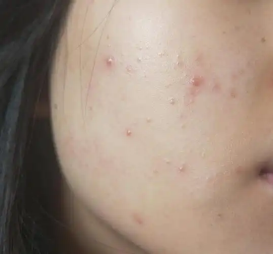 求助有没有姐妹帮我看看这长得什么痘痘慎入