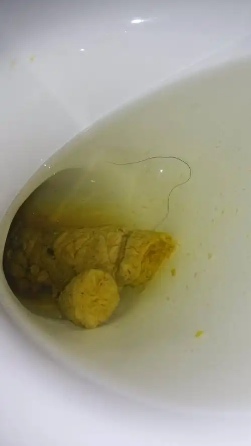 右下腹痛,一会儿痛一会儿不痛,大便很难排除,肝b超正常,胃镜胃炎,胸片