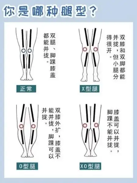 直乐大讲堂只是腿型不好看x型腿的痛你不懂