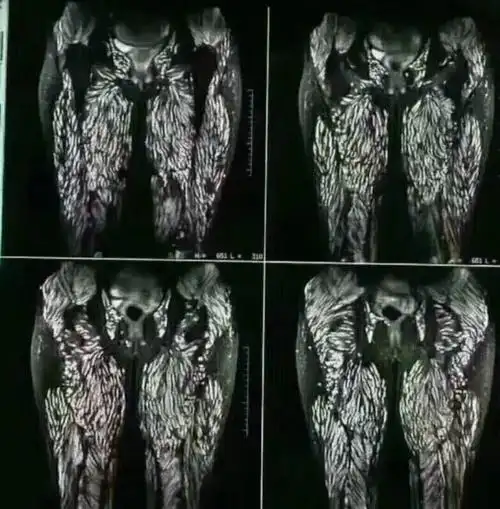 男子四肢内全是寄生虫恩施人注意专家提醒吃小龙虾别吃虾头