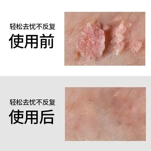 正品疣必清去疣灵清除阴道肛门湿尤必治肉粒男女丝状疣立净防复发