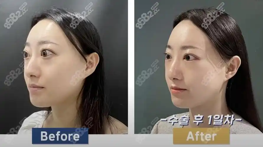 眼球突出矫正术