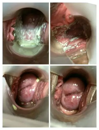 霉菌性阴道炎用药两次后效果图