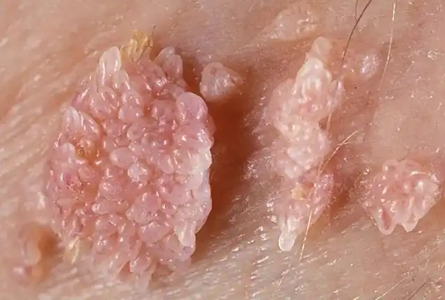 hpv感染导致的皮肤病(关于hpv病毒感染的四种皮肤病有哪些)(4)