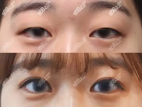 来看看我在南京康美找陈小剑做双眼皮怎样?还不错吧?