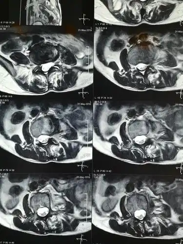 核磁共振显示椎管狭窄