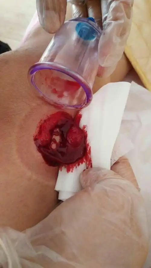 【拔罐】春天易感风邪,拔罐疗效最好!