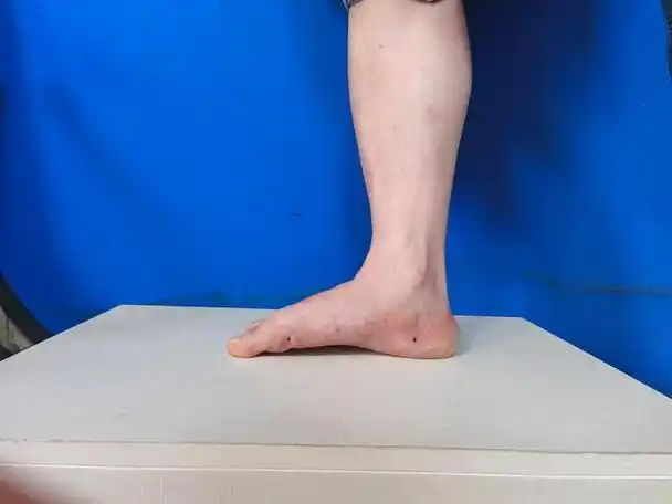 孩子扁平足怎么办?