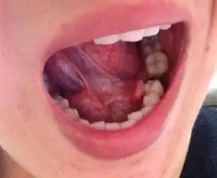 舌头底下长了一个包,不疼不痒.这个是什么情况,怎么办?