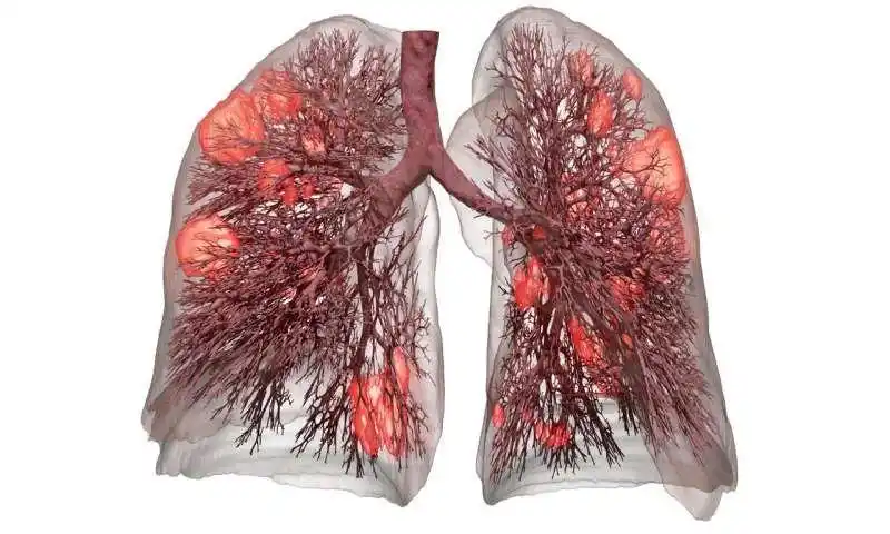 新的肺部模型让covid19患者机械通气更安全