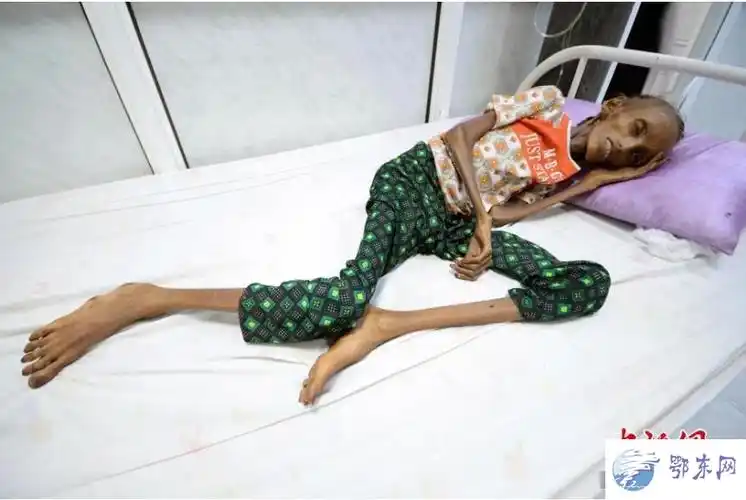 也门女孩如骷髅:因为饥饿竟瘦成骷髅形状