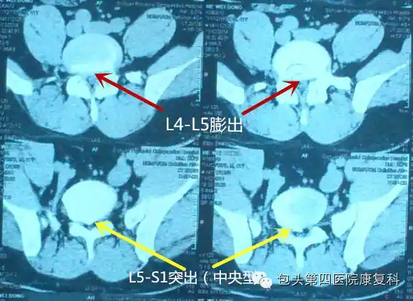 腰椎间盘突出症的影像学检查