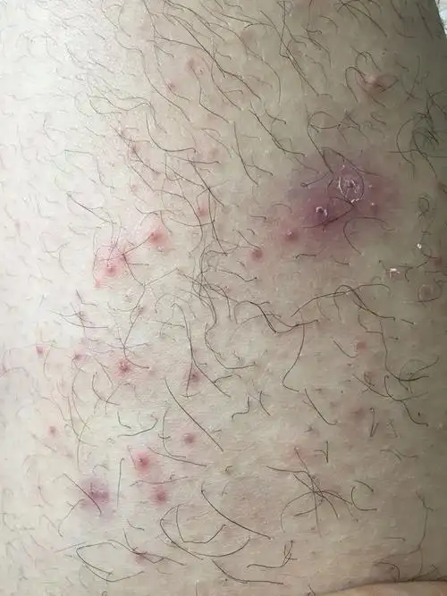 4 分钟前  最佳答案 毛囊炎,曲咪软乳膏涂抹几天就好了 追问 严重