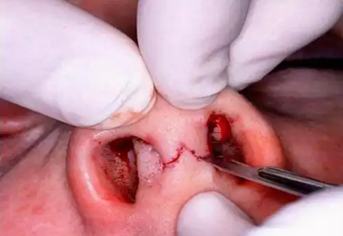 使用手指轻轻向上拉鼻尖部,手术切口略微裂开,可以看到已经切透了全层