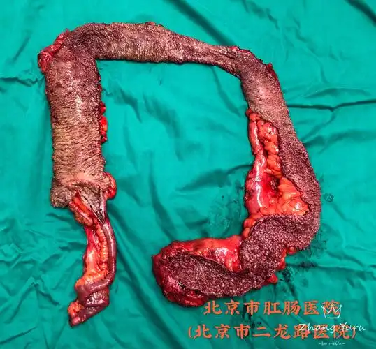 家族性腺瘤性息肉病(fap)