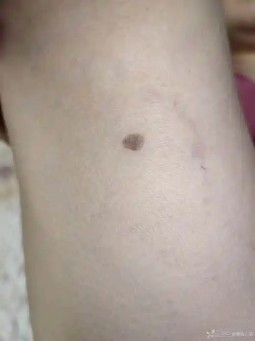 请教前辈同门这是黑色素瘤吗还是黑色素痣感谢