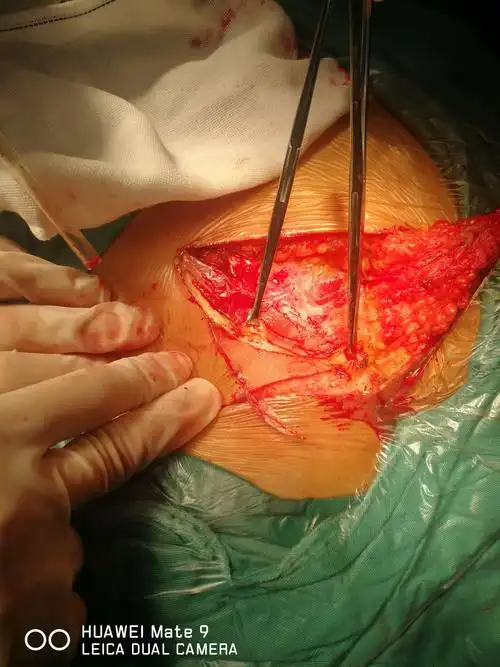 复发性骶尾部藏毛窦z型皮瓣成形术 胃肠胸外科 梁万明