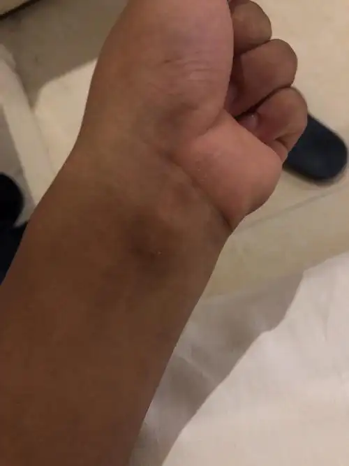 两只手腕黑黑的